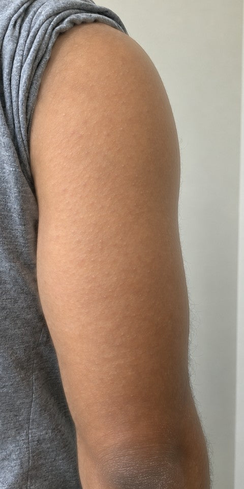 After 6 weeks: upper arm looks smoother