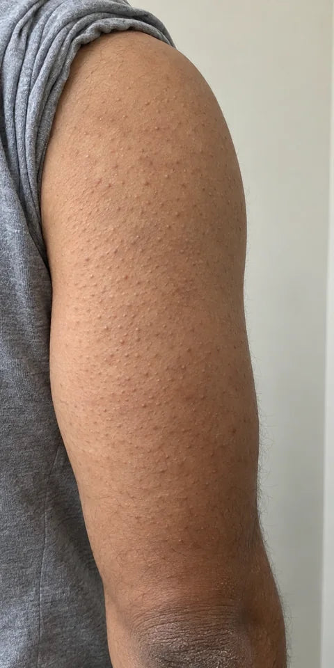 Before: rough texture on the upper arm